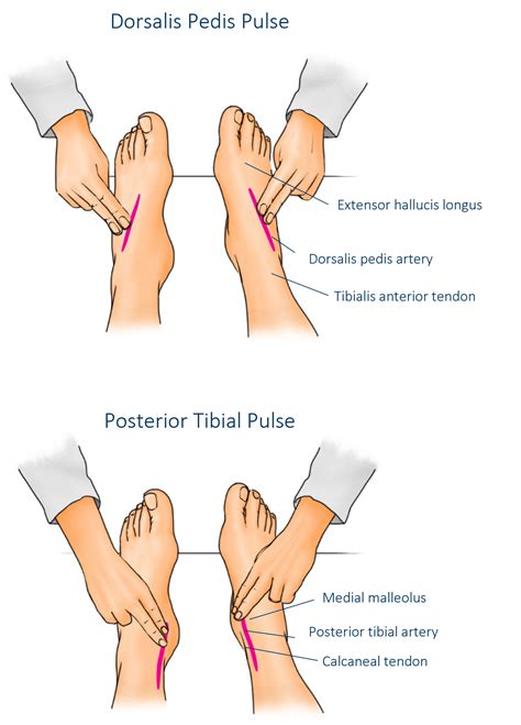 Pulse Assessment Dorsalis Pedis at Hector Myers blog