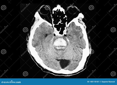 Pontine Hemorrhage Stock Photo | CartoonDealer.com #125417556 - hemorrhage in pons