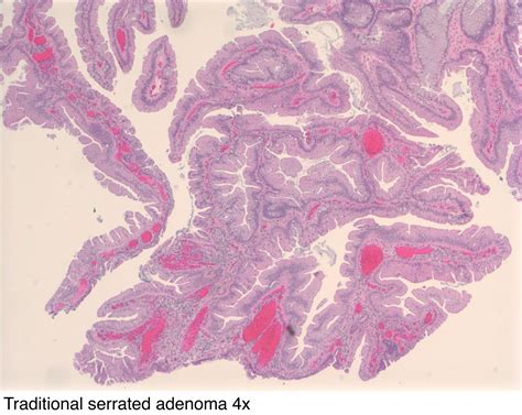 Pathology Outlines - Adenoma overview