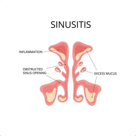 Home Remedies for Sinusitis Relief