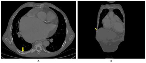 Paget’s Disease of Bone and Normocalcemic Variant of Primary ...