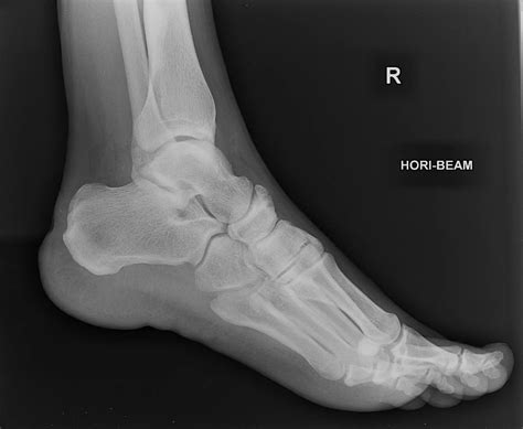 X-ray Left Heel Lateral/Axial | Test Price in Delhi | Ganesh Diagnostic