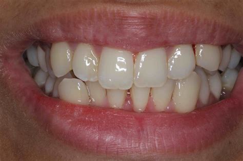 Porcelain Veneers or Braces? Make the Right Choice