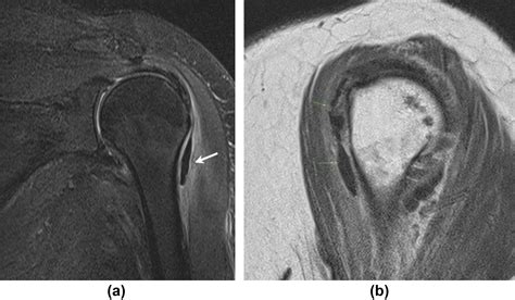 MRI findings in calcific deposits in and around shoulder: atypical locations beyond ...