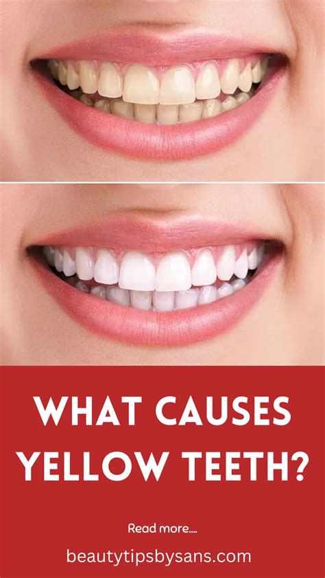 Causes of yellow teeth and its remedies | Teeth whitening, Natural teeth whitening, Tooth decay