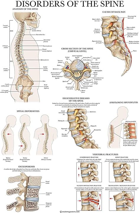 Disorders of the Spine Anatomy Poster - Laminated Spinal Disorders ...