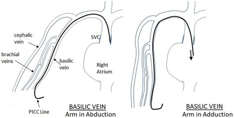 Antecubital Vein Picc Line