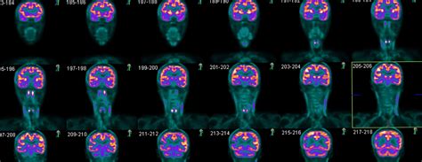 Image result for Add Brain Scan