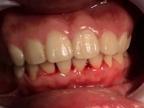 牙龈出血怎样治疗比较好-成都极光口腔医院