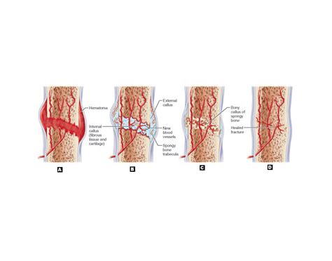 bone healing stages labeling Quiz
