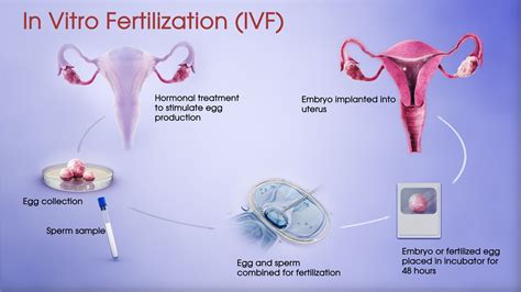 Image result for Vitro Fertilization IVF Process