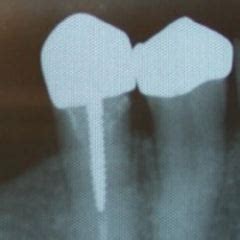 Angelus Reforpost Metallic - Intraradicular Posts by Dental Avenue