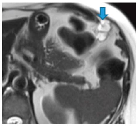 Unravelling Peritoneal Carcinomatosis Using Cross-Sectional Imaging ...