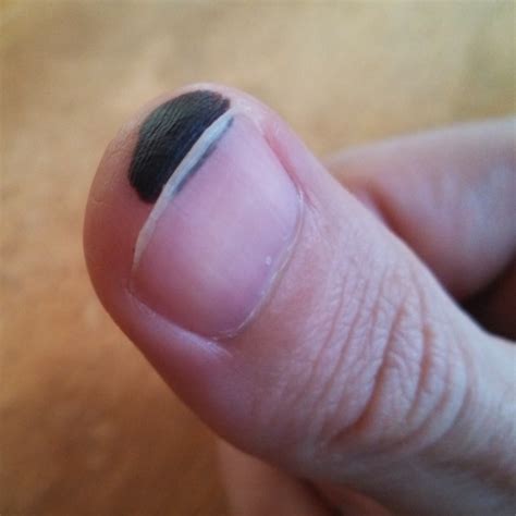 Kuvatulokset haulle blood blister