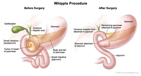 Whipple Procedure (Pancreaticoduodenectomy) - Pancreatic Cancer Action Network