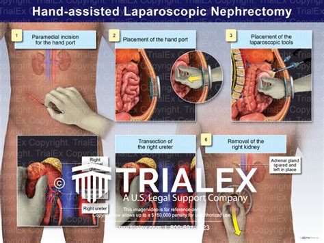 Image result for Hand-Assisted Nephrectomy