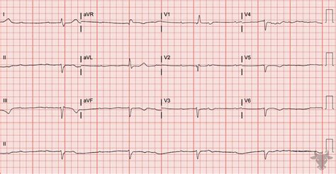Third Degree Atrioventricular Block | ECG Stampede