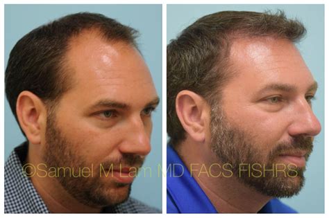advanced hair restoration reviews