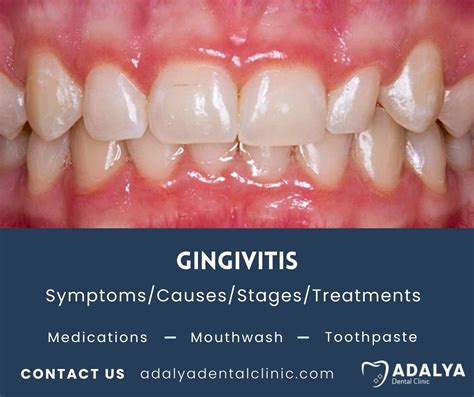 Gingivitis: Symptoms, Causes, Treatment | Adalya Dental Clinic