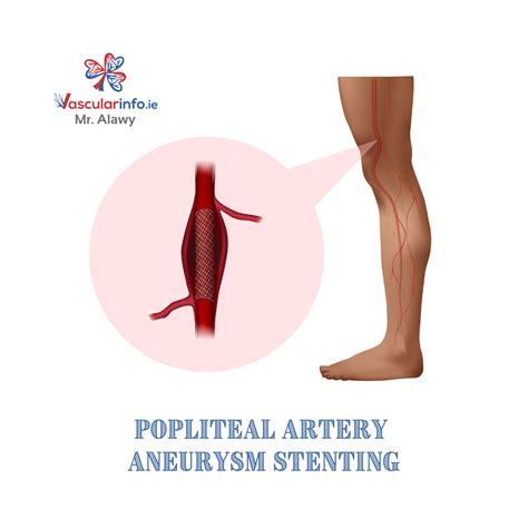Aneurysm In Leg