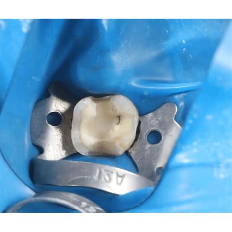 Buy GDC Rubber Dam Clamp Adult 13a (Rdc13a) – Oralkart