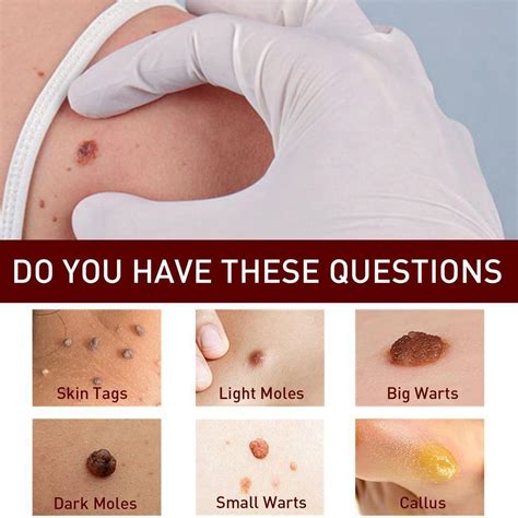 2X Common and Plantar Moles-Off Wartsoff Remover, | Ubuy India