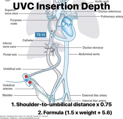 UVC insertion depth calculations. | Nicu nurse education, Nicu rn, Nicu nurse