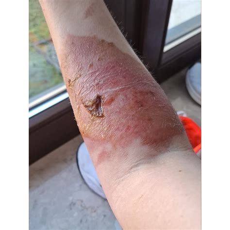 Dr. Mark Iwanicki- Rapid Healing of a Deep Partial-Thickness 2nd Degree ...