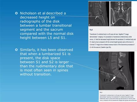 Transitional vertebrae radiology | PPTX