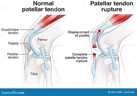Patellar Tendon Rupture. Knee Injury. Sports Injury. Knee Pain. Front ...