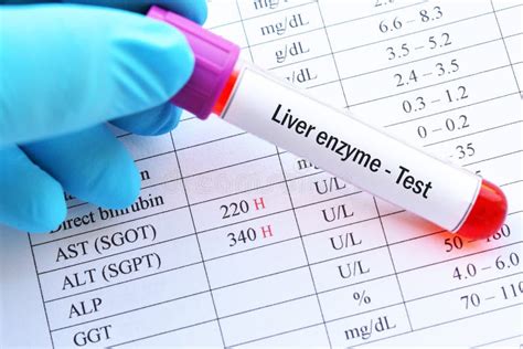 Image result for Liver Enzyme Lab Test