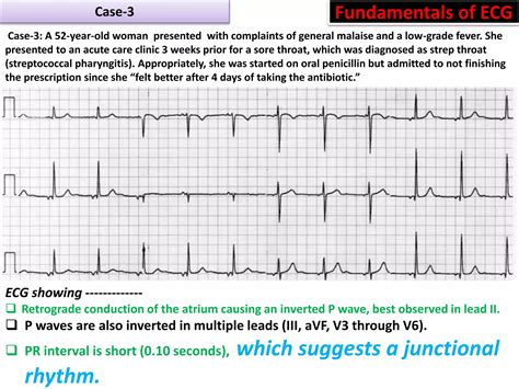 P wave abnormalities in ECG | PPSX