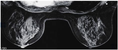【图】磁共振乳腺影像报告和数据系统 - 乳腺肿瘤学 - 天山医学院