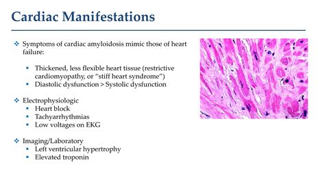 Ventricular Arrhythmias in Cardiac Amyloidosis.pdf | Heart and Cardiovascular Diseases ...