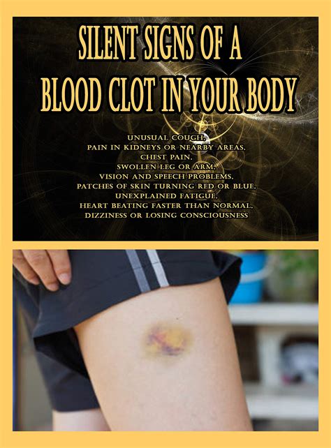 Silent Signs of a Blood Clot in Your Body: Unusual Cough, Pain in Kidneys or Nearby Areas, Chest ...