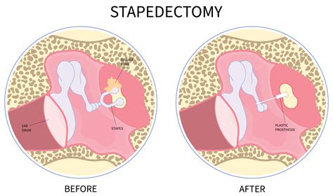 Stapedectomy Surgery in Dubai | Best ENT Surgeon in Dubai