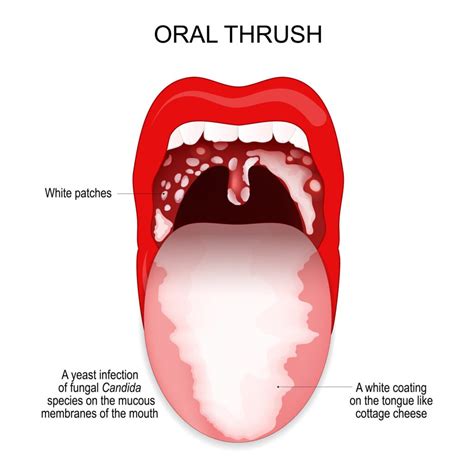 Oral thrush in adults online