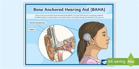 Bone Anchored Hearing Aid