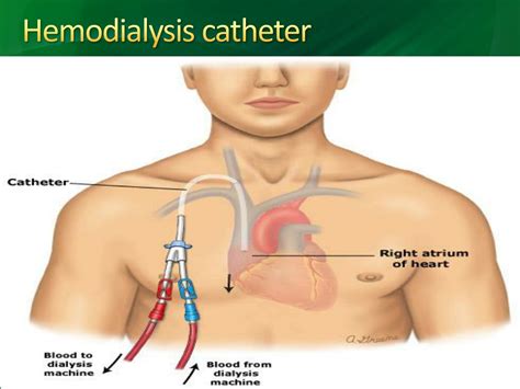 PPT - Renal Replacement Therapies PowerPoint Presentation, free ...