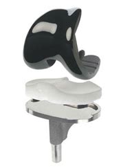 Total Knee Replacement | Orthonova Hospital - Jalandhar