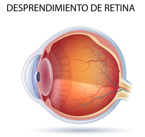 Desprendimiento De Retina