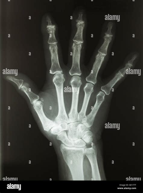 X Ray Hand Normal