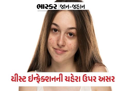 The effect of vaginal yeast infection on the face | વજાઇનલ યીસ્ટ ...