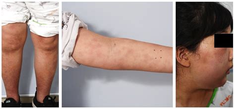 A Case of Pediatric Subcutaneous Panniculitis-like T-Cell Lymphoma ...