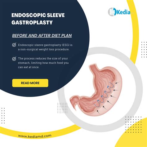 Endoscopic Sleeve Gastroplasty - Before and After Diet plan