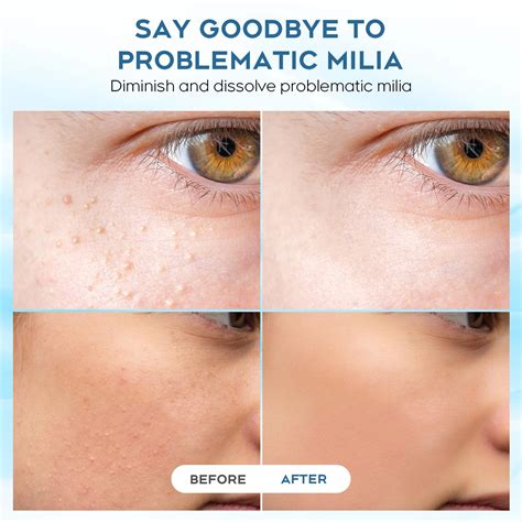 Milia Removal Before And After