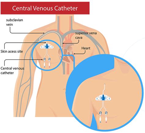 Image result for Purpose of CVC Line