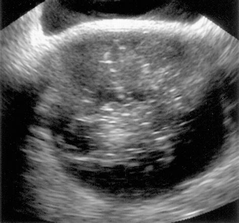 Ovarian Teratomas: Tumor Types and Imaging Characteristics | RadioGraphics