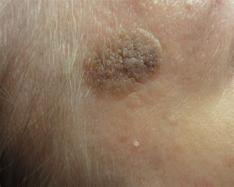 Seborrhoeic Warts, Hornchurch, Essex & London, Janice's Electrolysis Clinic