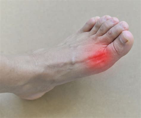 What Causes Gout In The Foot? – My FootDr